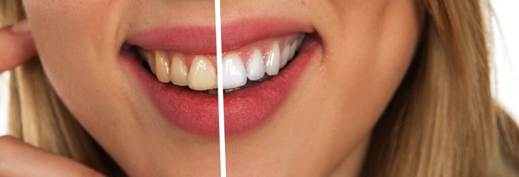 Qu’est-ce que le blanchiment dentaire ?